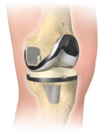 2. Abbildung des Persona®Kniesystems für eine Knieendoprothetik 
